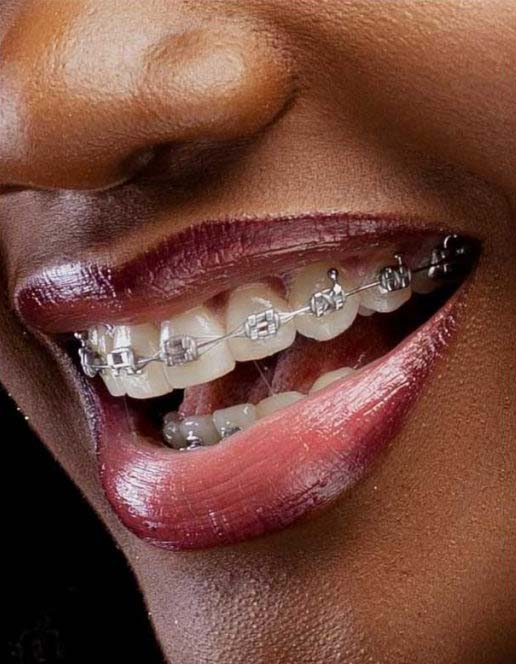 How Much Do Metal Braces Cost in Kenya: Cost of Dental Braces In