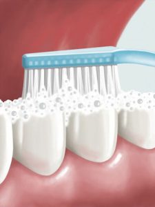 gingival cleaning